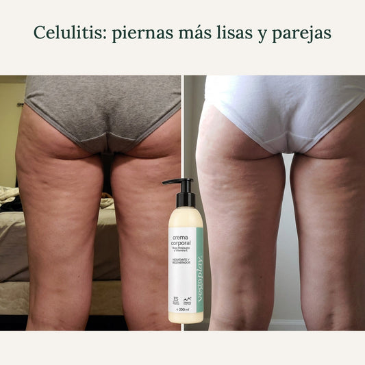 antes-despues celulitis piernas dia 1 dia 30