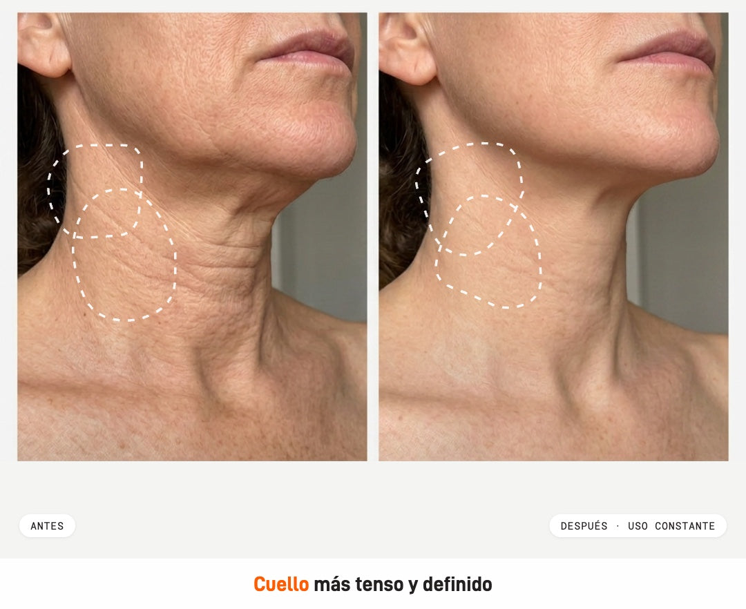 Antes y después · cuello y mentón · Kit Lift-Like Milaborit